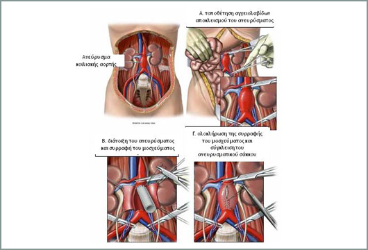 anebrisma-kiliakis-aortis-2