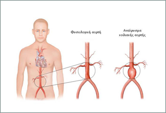 anebrisma-kiliakis-aortis-1